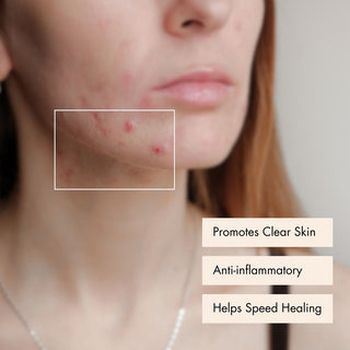 Clear Skin Balancing Treatment Oil