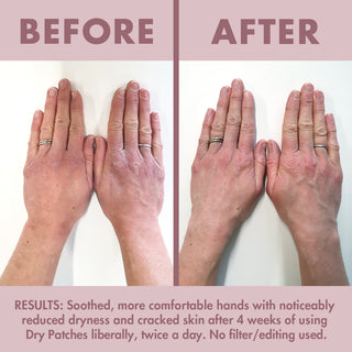 Dry Patches Soothing Intensive Balm for Dry Skin Eczema Prone Before and After Results