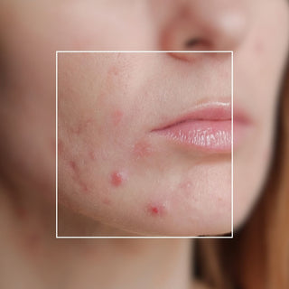 Essential Oils for Blemish-Prone Skin: The Five We Use
